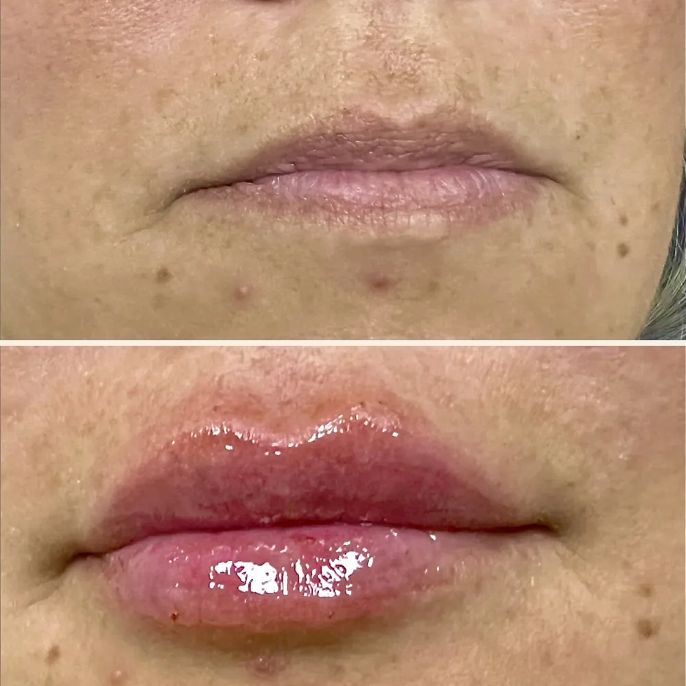 Lábios de uma paciente antes (acima) e depois (abaixo) do preenchimento labial