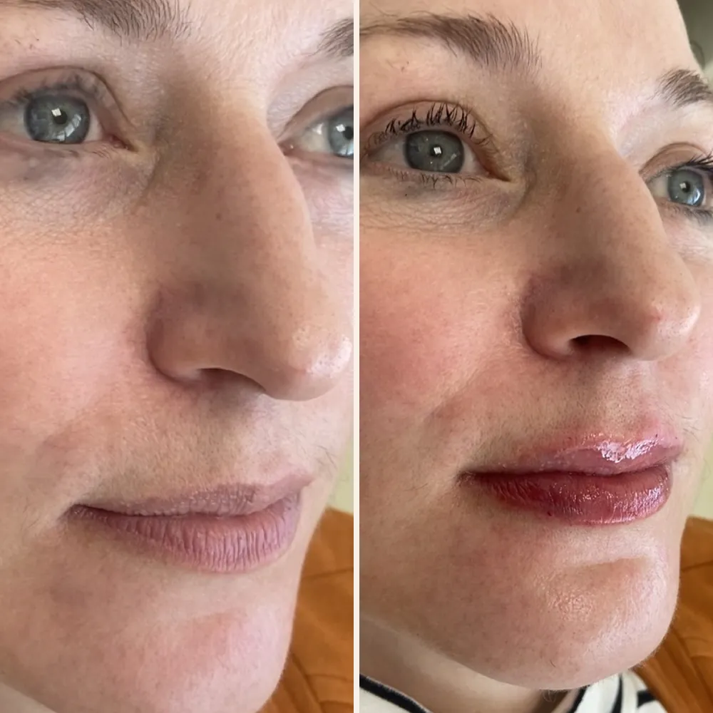 Rosto de uma paciente em três quartos, antes (à esquerda) e depois (à direita) do preenchimento labial