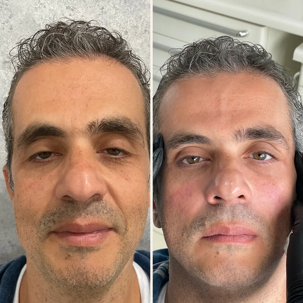 Rosto de um paciente de frente, antes (à esquerda) e depois (à direita) da harmonização facial completa