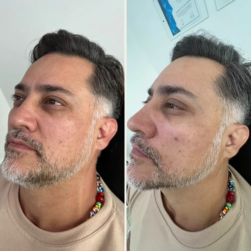 Rosto de um paciente em três quartos, antes (à esquerda) e depois (à direita) do preenchimento de olheira, malar e contorno mandibular
