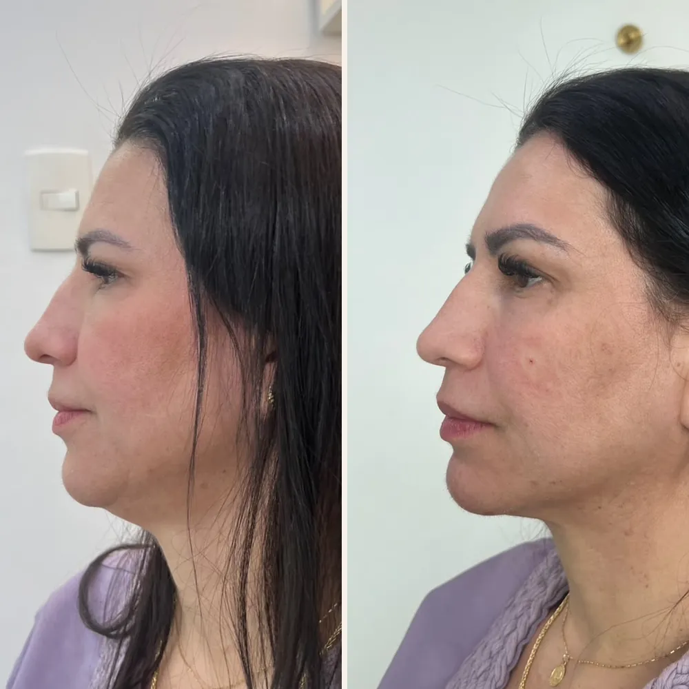 Perfil de uma paciente antes (à esquerda) e depois (à direita) do preenchimento de queixo e malar, com o contorno do queixo mais definido