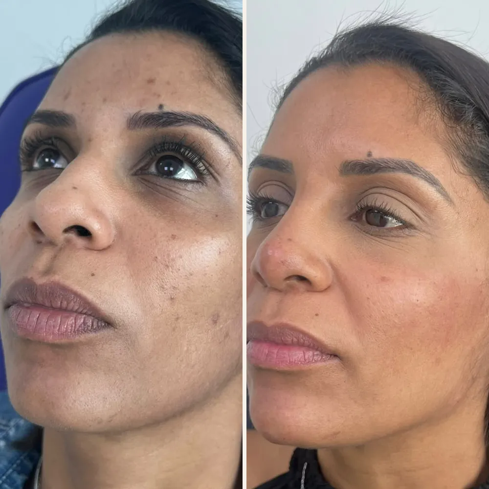 Rosto de uma paciente em três quartos, antes (à esquerda) e depois (à direita) de rinomodelação, preenchimento malar, de mento e contorno mandibular