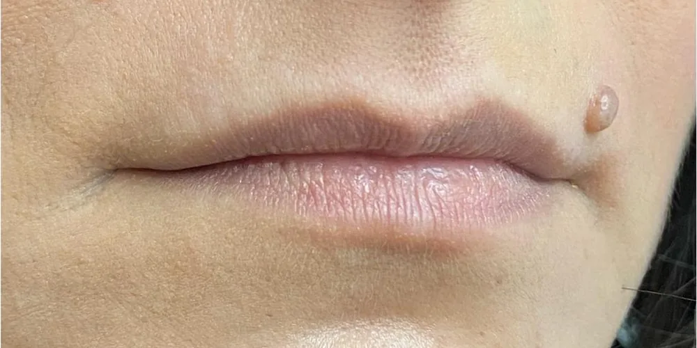 Lábios da paciente antes do preenchimento labial