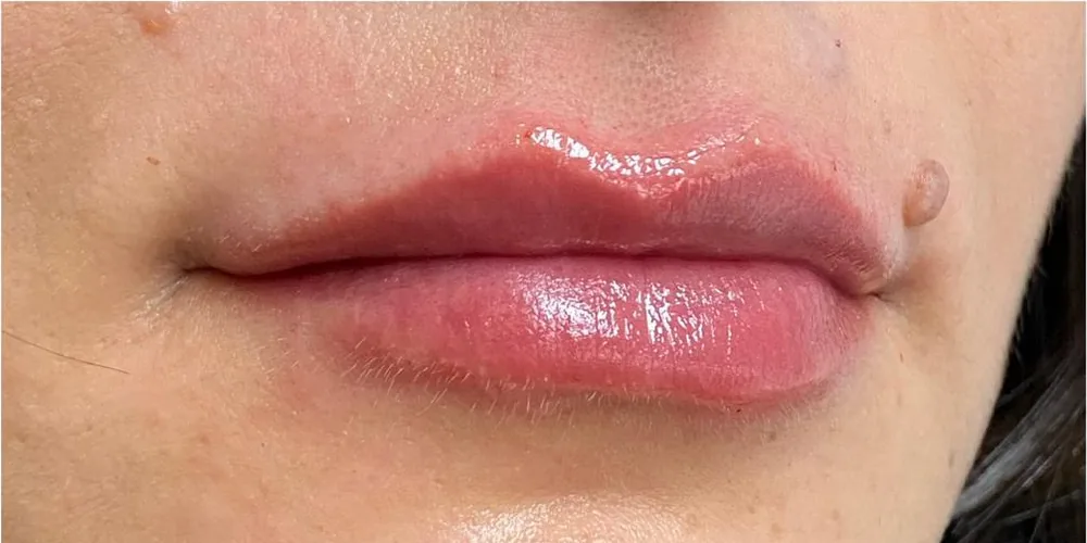 Lábios da mesma paciente depois do preenchimento labial, com contorno mais definido